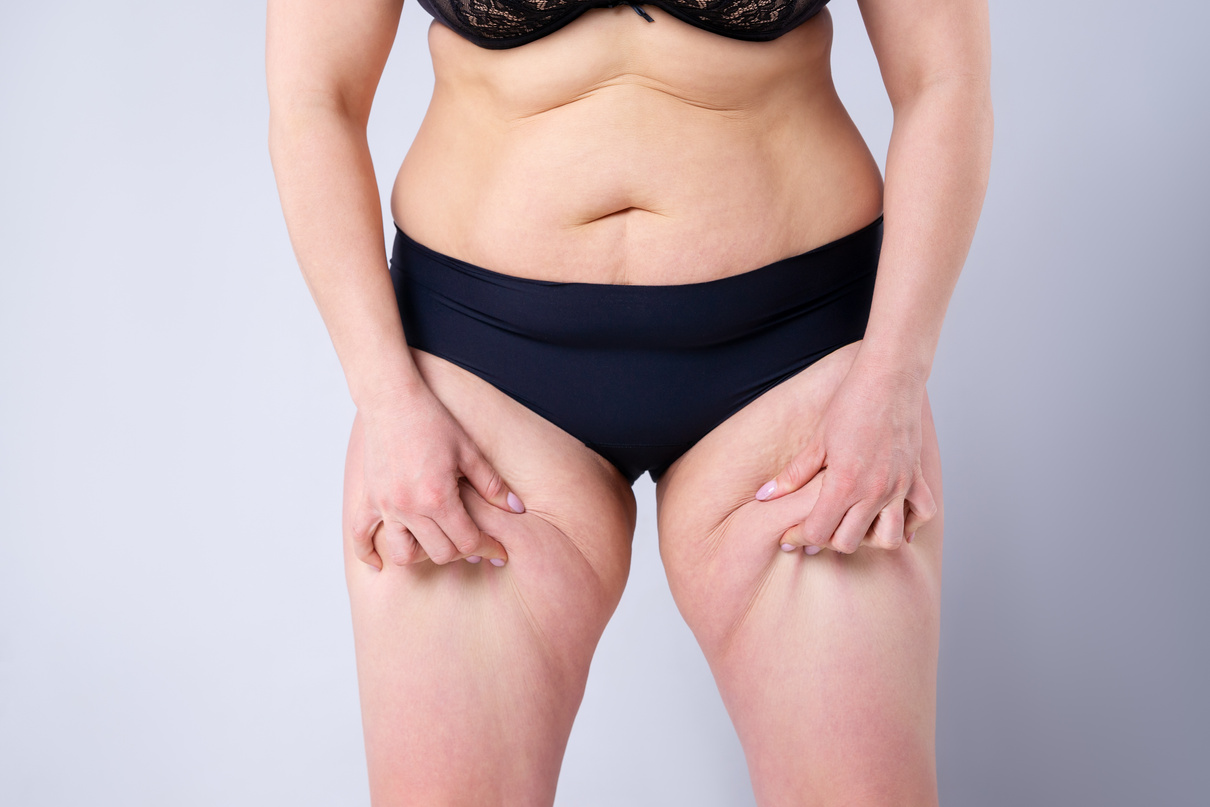 Curvy Female Gripping onto Excess Skin